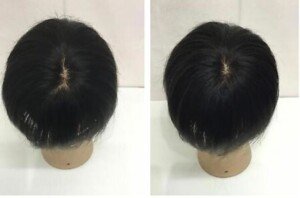 部分増毛-300x198 (1)